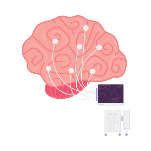Illustration of a brain with electrodes wired to a monitor showing waveforms